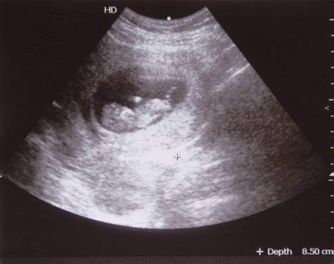 Early Pregnancy Ultrasound Results