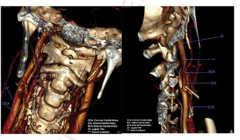 Figure 2 From Traumatic Bilateral Dissection Of Cervical Internal