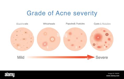 Medical Diagram About Grade Of Acne Severity Stock Vector Image And Art