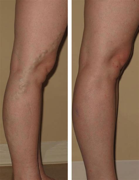 What Are Varicose Veins Causes Symptoms And Treatment Brandon