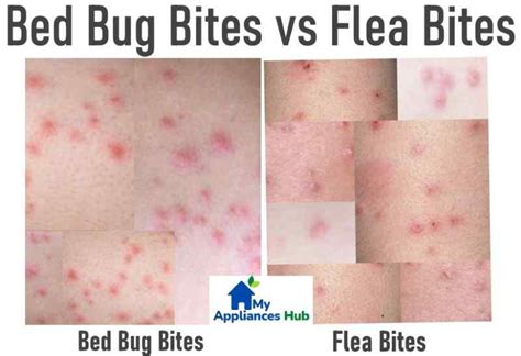 Bed Bug Bites Vs Flea Bites Spot The Difference And Get Relief 2023