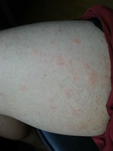 Pinprick Red Dots On Skin Itchy Terrifying Photos Show Deadly