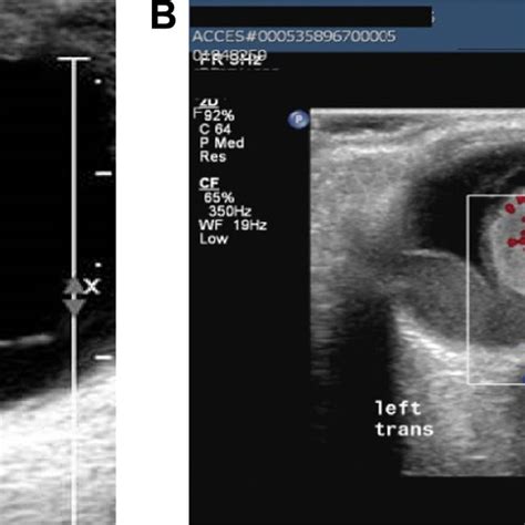 Choroidal Melanoma On Mri And Ultrasound Scan Notes A Homogeneous