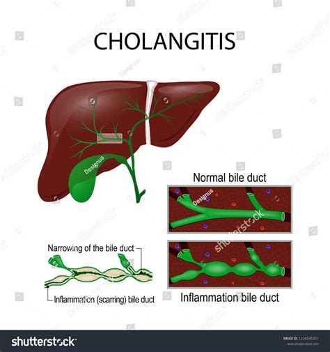 Cholangitis Ascending Cholangitis Acute Cholangitis Is An Infection
