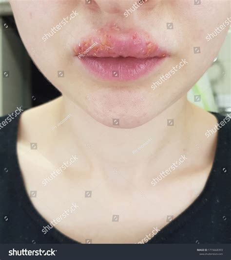 Cold Sore Lips Herpes On Lips Stock Photo 1715668393 Shutterstock