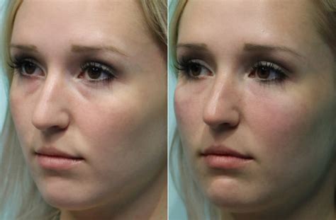 Injections Tear Trough Under Eye Injections Photos Chevy Chase Md