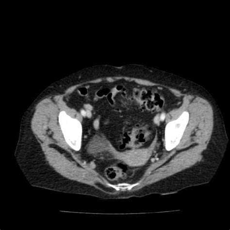 Rolling Paraesophageal Hiatus Hernia Radiology Case