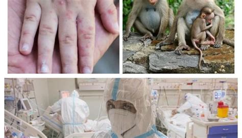 „variola Maimuţei” Boala Care Face Ravagii în Anglia Ce Simptome Au
