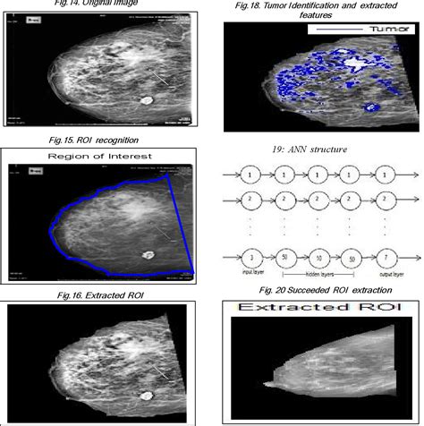 figure 20 from solving mammography problems of breast cancer detection using artificial neural