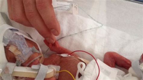 Miracle Baby Born Weighing Just 1ib 3oz Gets Set To Celebrate His First