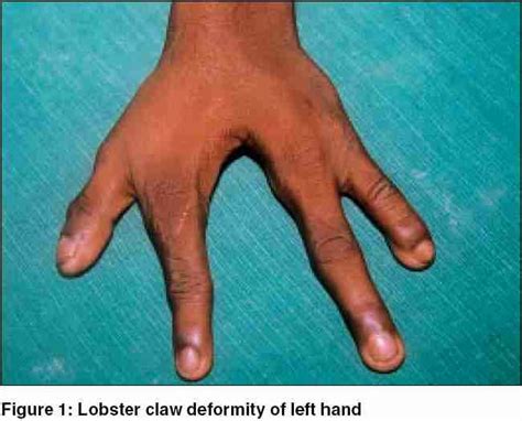 ectrodactilia of the hand claw hand and foot syndrome by erick medical phenomenons