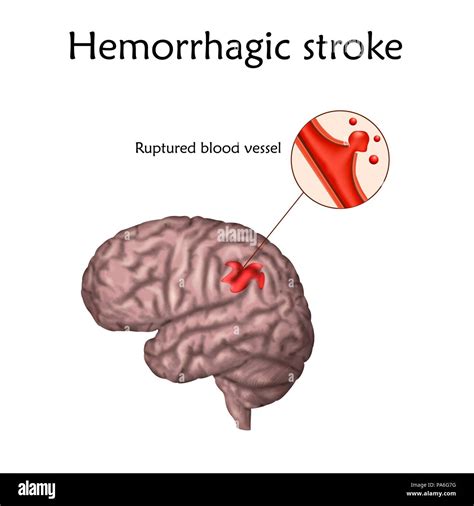 Haemorrhagic Stroke Illustration Of A Ruptured Blood Vessel In The