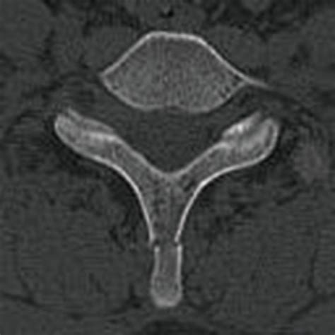 Fracture Of C7 Spinous Process Download Scientific Diagram