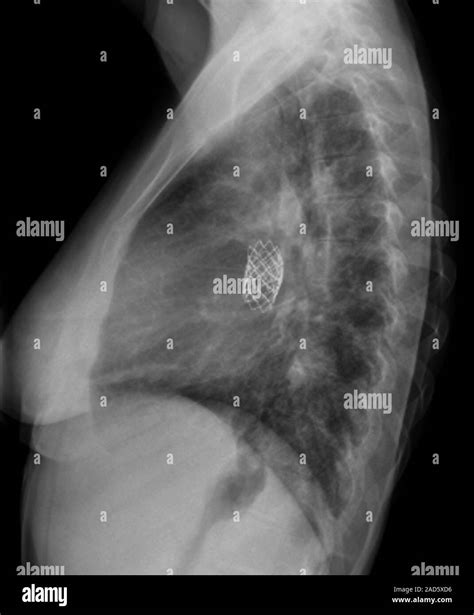 Cardiopathies Congénitales Radiographie Latérale De La Poitrine Dune