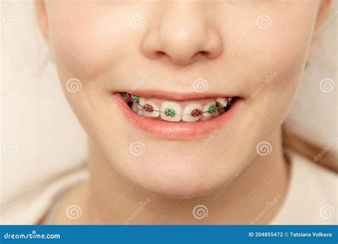 closeup multicolored red and green braces on teeth beautiful female smile with braces