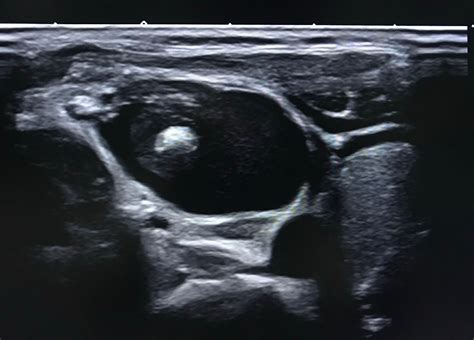 Vietnamese Medic Ultrasound Case 552 Ultrasound Of A Cystic Neck Mass