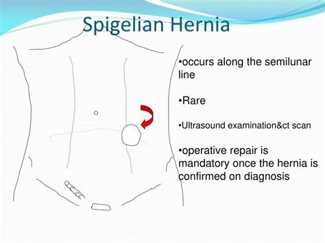 Ppt Hernia Powerpoint Presentation Id2957512