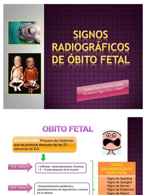 Signos Radiográficos De Óbito Fetal Pdf