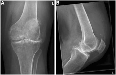 An X Ray Of The Left Knee Showed Severe Osteoarthritis Open I