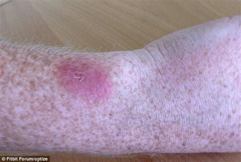 Rashes Blisters Peeling Skin Users Of 130 Dollar Wrist Worn Fitbit
