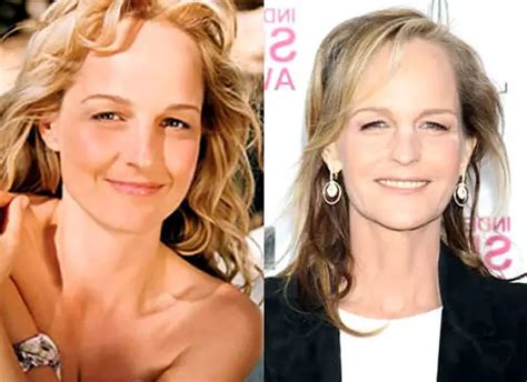 Helen Hunt Facelift Plastic Surgery Before And After Celebie