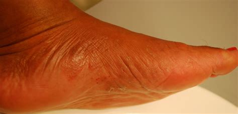 Itchy Red Rash On Soles Of Feet