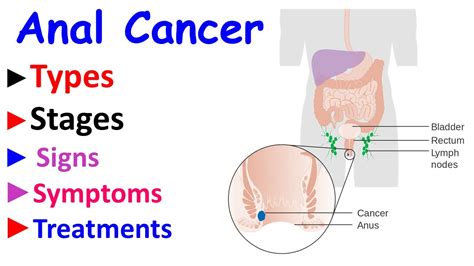 Anal Cancer Intro Types Stages Signs Symptoms And Treatment Options Youtube