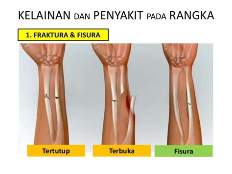 Gastritis merupakan salah satu gangguan pencernaan yang terjadi di lambung. AntiyZm: Gangguan dan kelainan pada sistem gerak.