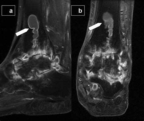 Giant Intraosseous Synovial Cyst With Intraarticular Communication With