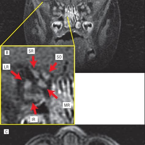 Preoperative Magnetic Resonance Image Of Patient 1 With Congenital