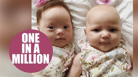 Meet The One In A Million Twins One With Downs Syndrome And The