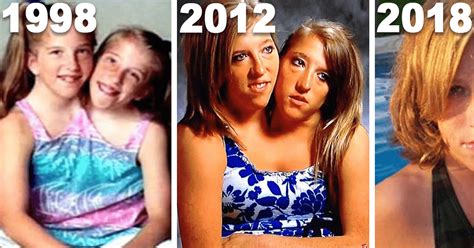 What Conjoined Twins Abby And Brittany Hensel Look Like Today With
