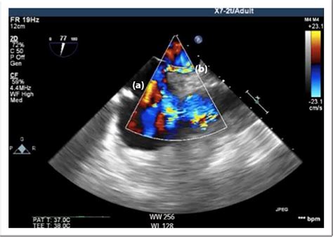 Figure 2 From Percutaneous Closure Of Patent Foramen Ovale In The