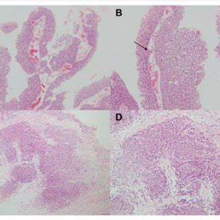 Papillary Urothelial Carcinoma Of The Urinary Bladder And Metastatic