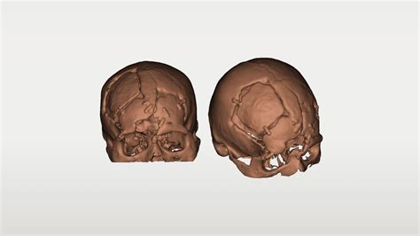 How 3d Printing Helped Doctors Reconstruct A 3d Skull