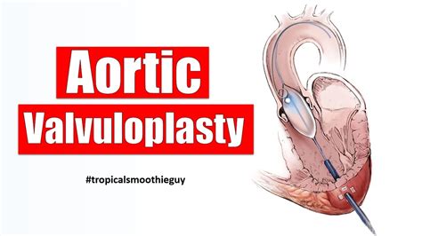 How Aortic Valvuloplasty Works Youtube