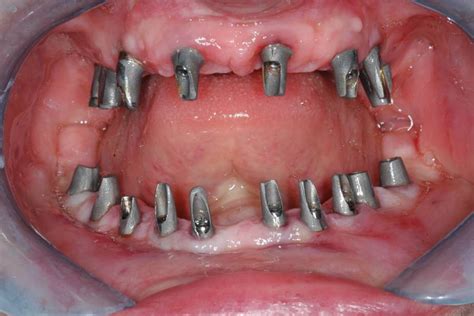 Case Study 9 Full Mouth Dental Implants Dental Implant