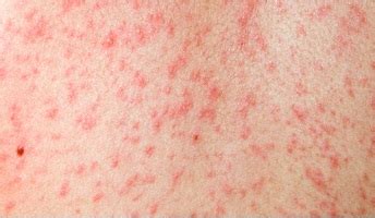Walaupun chicken pox bukanlah satu penyakit yang berbahaya, ikut diet sepert yang diberikan di atas. Kisah Anak-anakku: measles vs chicken pox