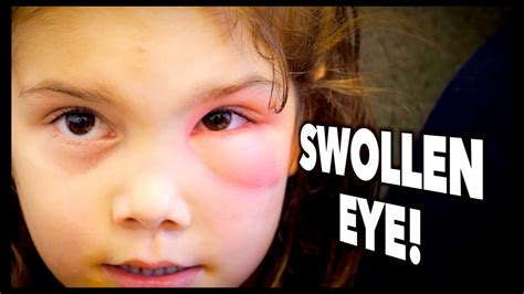 Woke Up With A Swollen Eye Discount Save 49 Jlcatjgobmx
