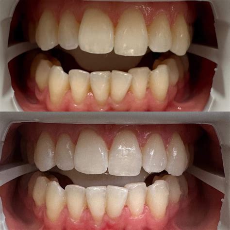 Teeth Whitening Queenstown | Wake Up With Make Up