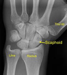 Scaphoid Fracture | Wrist Bone Fracture | Wrist Surgery ...