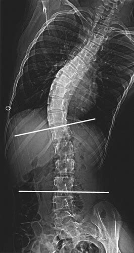 Download ray season 1 hindi: Scoliosis Imaging: What Radiologists Should Know ...