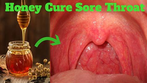 Watch How Honey Treats Sore Throats And Coughs YouTube
