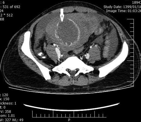 the axial contrast enhanced ct scan shows a large hypodense download scientific diagram