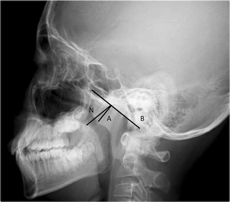 Measurement Of The Adenoidalnasopharyngeal An Ratio On Lateral