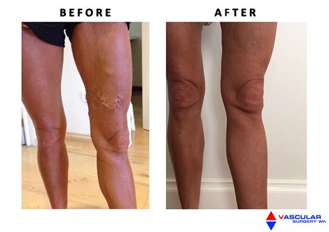 Flut Unser Unternehmen Reiben Varicose Veins Laser Treatment Aftercare