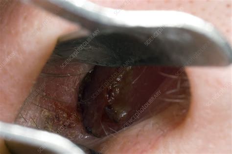Inflamed Nostril