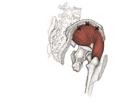 Gluteus Medius Trigger Points