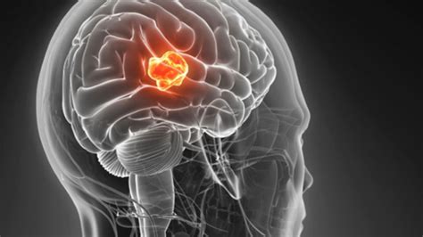 Case Presentation Minimally Invasive Laser Ablation Treatment For Brain Tumor Johns Hopkins