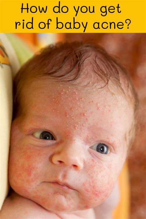 She never had a baby. Why Do Babies Get Baby Acne? - Preemie Twins Baby Blog